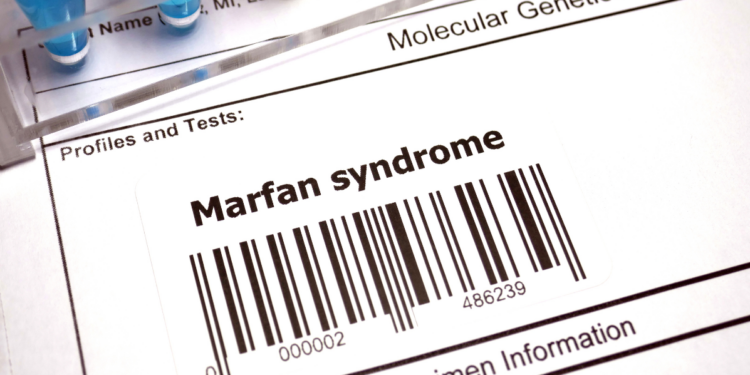Zespół Marfana to genetycznie uwarunkowane zaburzenie